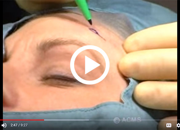 American College of Mohs Surgery (ACMS) Patient Education Video